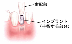 歯冠部とインプラント