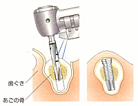 一次手術