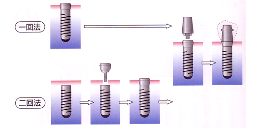 一回法と二回法