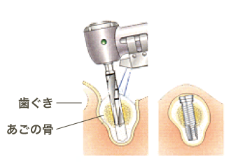 一次手術