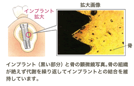 オッセオインテグレーション