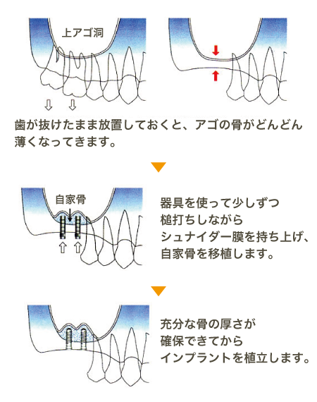 ソケットリフト